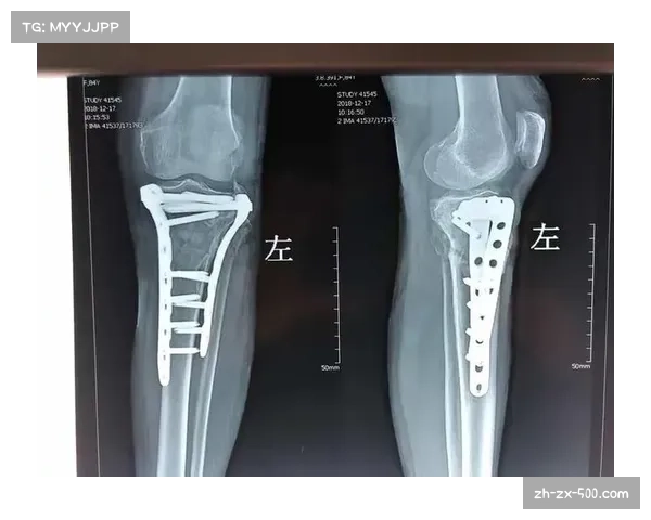 广西平果外援阿萨莫阿颈部骨折成功手术治疗目前恢复情况良好 广西平果外援阿萨莫阿颈部骨折成功手术治疗目前恢复情况良好